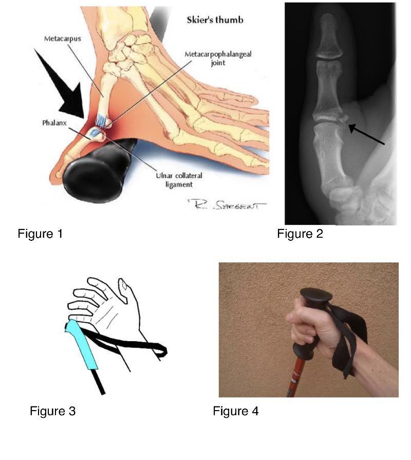 MEDICAL MOMENT SKIER'S THUMB? AVOID IT! Telluride Inside... and Out